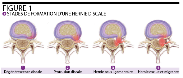 Kiné – Prise en charge d’un patient atteint d’une hernie discale