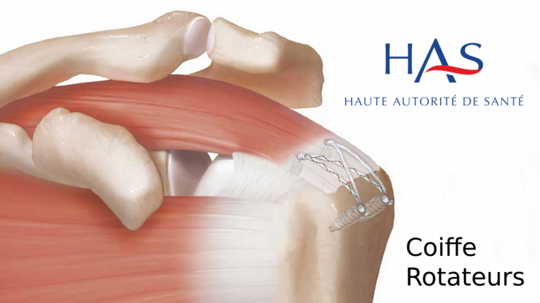 rupture-coiffe-rotateurs