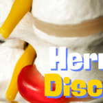hernie discale