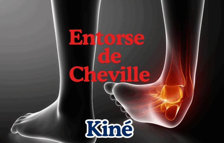 entorse de cheville